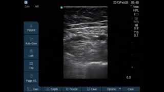 Saphenous Nerve block at adductor canal for Knee Arthroscopy [upl. by Netnerb]