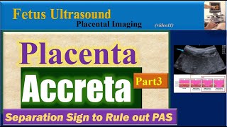 Fetus Ultrasound Placenta Accreta Part3 [upl. by Eirrak]