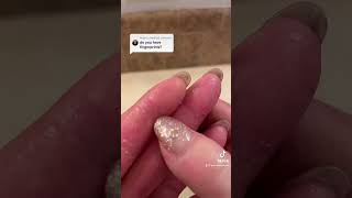 Do I have fingerprints Epidermolytic Palmoplantar Keratoderma  Jan 20 2023 [upl. by Latimer]