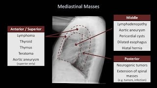 Spinal ependymoma  radiology video tutorial MRI [upl. by Leilani413]