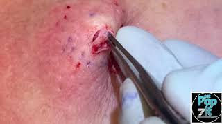 Chest popper blackhead with underlying cyst Big squeeze and cyst pop Full excision and closure [upl. by Clapper]