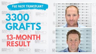 Manual FUE Hair Transplant Before amp After 3300 Grafts 13Month Result  ASMED  Dr Koray Erdogan [upl. by Virginia908]