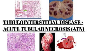 ACUTE TUBULAR NECROSIS  TUBULOINTERSTITIAL DISEASE PART 01 IMAGES [upl. by Htesil]