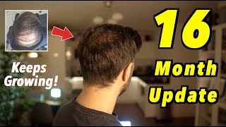 16 Month 2nd Hair Transplant Update  4000 GRAFTS FUE  STILL GROWING [upl. by Chandos]