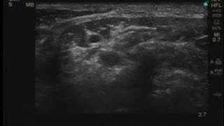 UltrasoundGuided Selective Cervical Nerve Root Block [upl. by Annadiana]