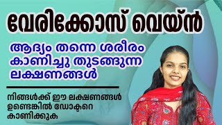 വേരിക്കോസ് വെയ്ൻ കാരണമെന്ത്   Varicose Vein Malayalam varicoseveins [upl. by Solegna707]