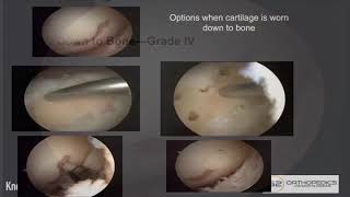 Treatment Options When Cartilage Is Worn Down to Bone [upl. by Vittorio]