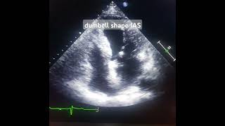 Lipomatous hypertrophy IAS cardiac benign tumor [upl. by Marston]