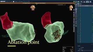 3D mapping electrophysiology study and ablation  ventricular tachycardia storm in AICD patient [upl. by Nosemaj]