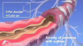 Asthma Medical Animation [upl. by Mischa]