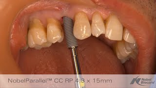 Immediate placement amp provisionalization in maxillary esthetic zone │ NobelGuide amp NobelParallel CC [upl. by Attenhoj]