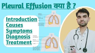 Pleural Effusion in Hindi  Causes Sign and Symptoms Treatment of Pleural effusion [upl. by Ahsenav]