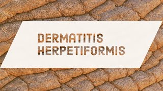 Dermatitis Herpetiformis [upl. by Yrffoeg]