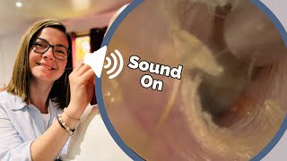 Double Earwax Blockage Removal with sound [upl. by Annawak]