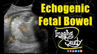 Echogenic Foci in fetal heart बच्चों पर इसके प्रभाव [upl. by Narad]