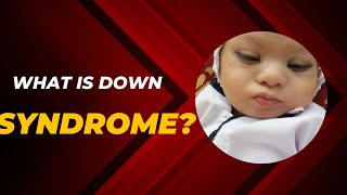 What is down syndrome [upl. by Akinor767]