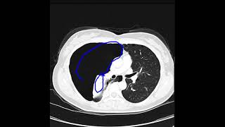 Pneumothorax due to lymphangioleiomyomatosis [upl. by Madelina]