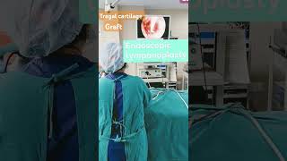 एंडोस्कोपिक टिम्पेनोप्लास्ट ENDOSCOPIC TYMPANOPLASTY endoscopicearsurgerytympanoplastyyoutube [upl. by Namilus]