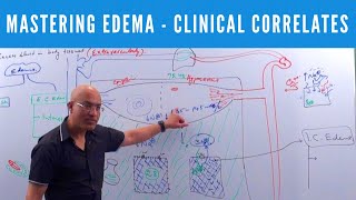 Mastering Edema  Types Causes Symptoms amp Treatment 👨‍⚕️ [upl. by Beyer]