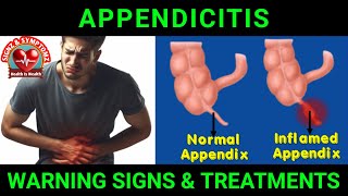 Appendicitis Symptoms and Treatment Options appendicitis [upl. by Aivad949]