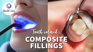 Composite Fillings  Composite filling procedure  Composite bonding to the tooth [upl. by Nosreve394]