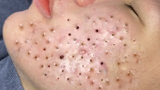 Blackheads removal acne blackheads whiteheads removal8372 [upl. by Lachance97]