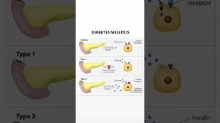 Metabolic disorder Diabetes Mellitus Type1 and Type2 [upl. by Kyrstin]