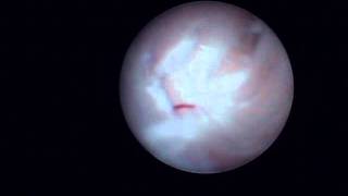 Arthroscopy of the Jaw Temporomandibular Joint TMJ  Part 3 [upl. by Simonsen]