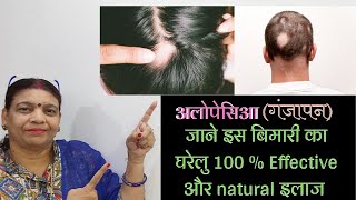 Alopecia Treatment For Men Hindi  Alopecia Ka Natural ILaj  Hair Loss Treatment For Men Alopasia [upl. by Dyana]