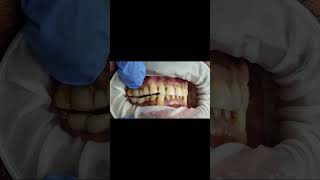 Lower implant molar bridge bite check with Bausch 40 micron articulating paper test shorts [upl. by Darell]