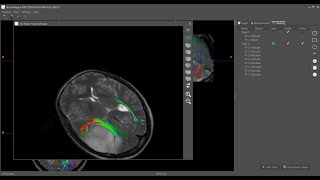 BrainMagix 3D Fiber Tracking [upl. by Mame]