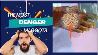 MAGGOTS  MAGGOTS IN MAN FOOT  MAGGOTS REMOVAL [upl. by Attikram]