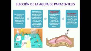 Paracentesis Abdominal [upl. by Eirtemed403]