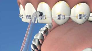 Uso del cepillo interdental o interproximal [upl. by Ydniahs]