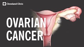 5 Warning Signs and Risk Factors of Ovarian Cancer [upl. by Patrice]