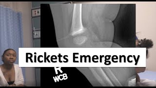 Rickets in the Pediatric Emergency Department [upl. by Naginarb]