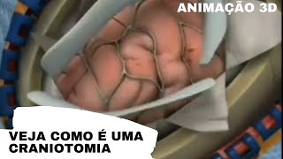 Veja como é uma Craniotomia em 3D  Neurologia  Medicina Geral [upl. by Leina]