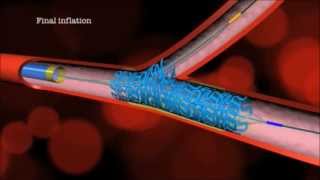 Main Branch Bifurcation Stent quotPROVISIONALquot by Advanced Bifurcation Systems [upl. by Johppah]