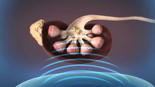 Shockwave Lithotripsy SWL [upl. by Yddor]