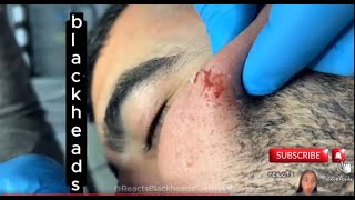 THE EASIEST Way to Remove BLACKHEADS and WHITEHEADS blackhead extraction [upl. by Auhoj808]