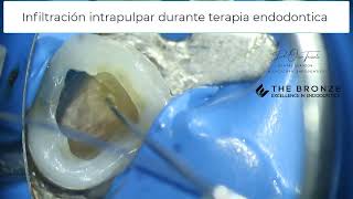 Anestesia intrapulpar durante terapia endodontica [upl. by Alamat144]