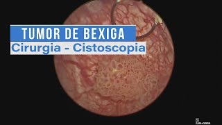 Tumor de Bexiga  Cirurgia  Cistoscopia [upl. by Steady]