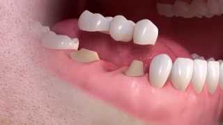 Straumann  Conventional 3unit bridge treatment [upl. by Alesig]