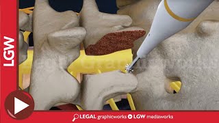 L5S1 Lumbar Discectomy and Fusion Surgery 3D animation [upl. by Assetan]