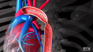 Stenting of Coarctation of the Aorta using a NuMed CP Stent  BVM Medical [upl. by Carroll357]