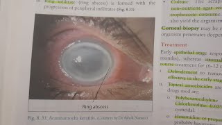 Acanthamoeba Keratitis  EYE [upl. by Ormsby209]