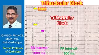 Trifascicular Block [upl. by Rehpatsirhc]