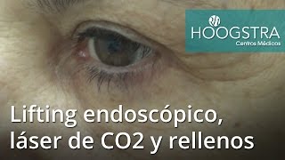 Lifting endoscópico láser de CO2 y rellenos faciales 16058 [upl. by Ardnaid326]