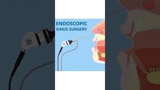 Balloon Sinuplasty vs Endoscopic Sinus Surgery [upl. by Andi]