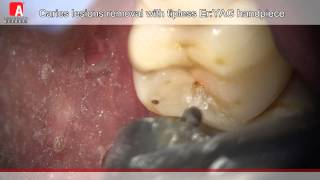 Caries Removal amp Cavity Preperation with Fotona Lightwalker ErYAG Laser [upl. by Natanhoj249]